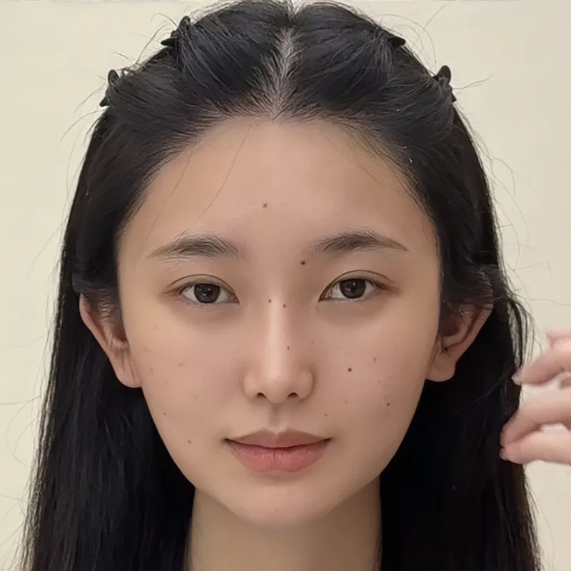 生え際の位置調整と輪郭——女性症例 — After · 症例 1