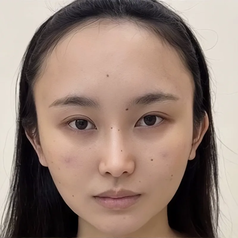 生え際の位置調整と輪郭——女性症例 — Before · 症例 1