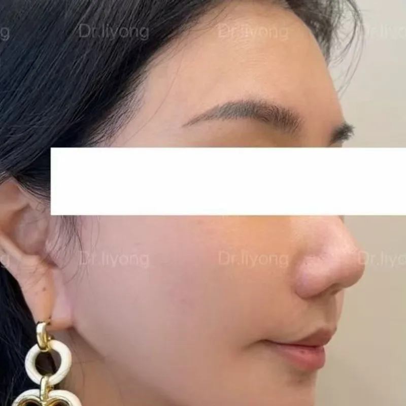 Three-step facial lift — six months after — After · Case 1