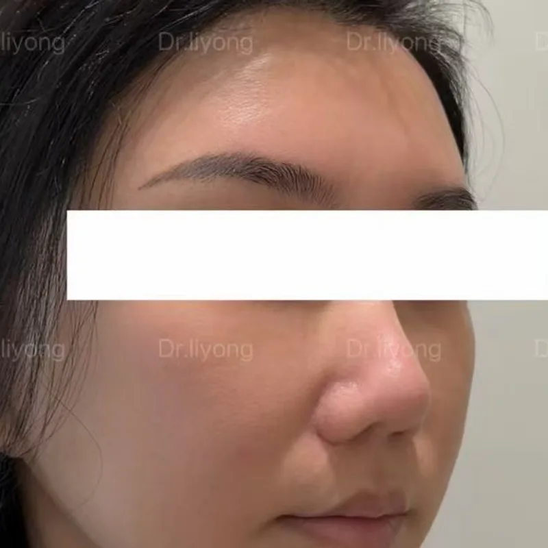 Three-step facial lift — six months after — Before · Case 1