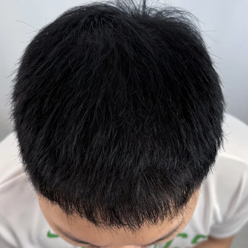 生え際と毛量——男性症例 — After · 症例 1