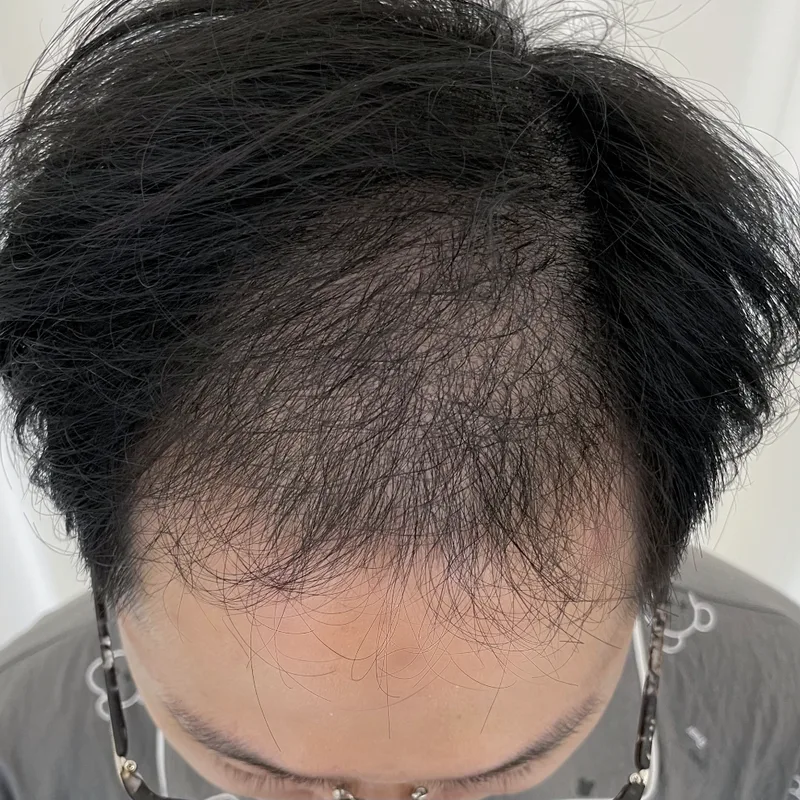 生え際と毛量——男性症例 — Before · 症例 1
